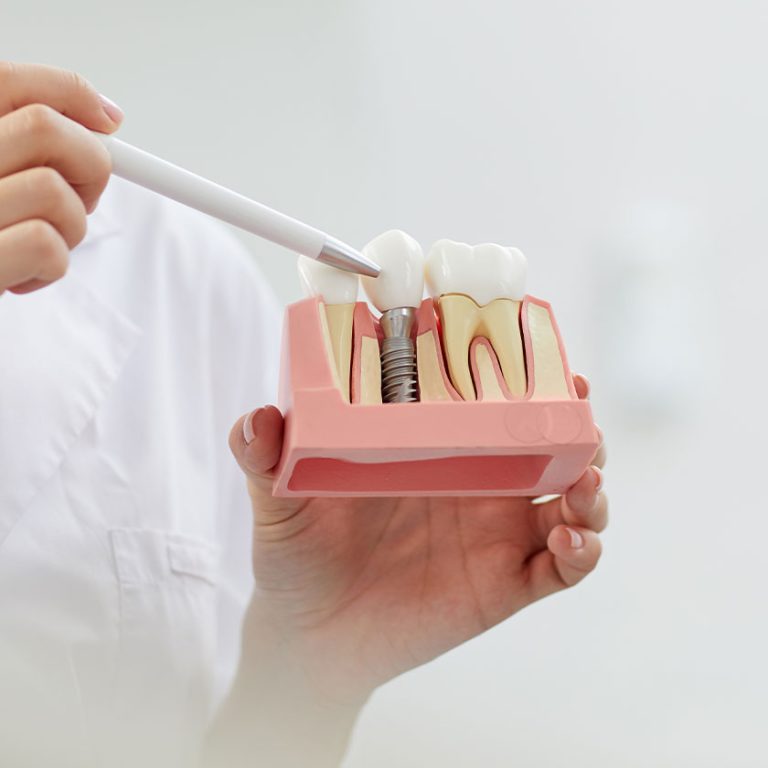 implant-tedavisi-sonrası-bakım